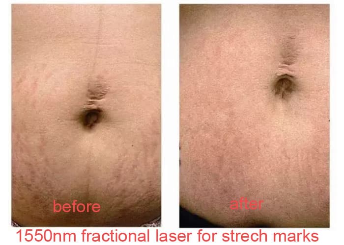 1550nm Laser  For Wrinkles _ Stretch Marks Removal